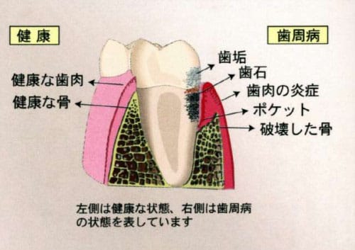 歯周病