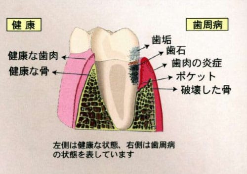歯周病（歯槽膿漏）ってどんな病気？